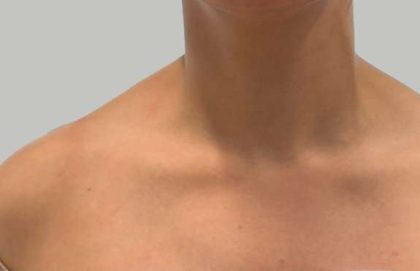Botox/Dysport Before & After Patient #837