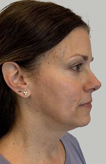 HALO/BBL Before & After Patient #1002