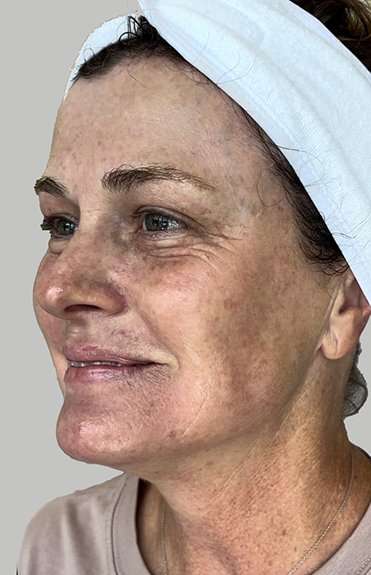 HALO/BBL Before & After Patient #1005