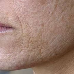 HALO/BBL Before & After Patient #1008