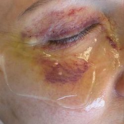 HALO/BBL Before & After Patient #1013