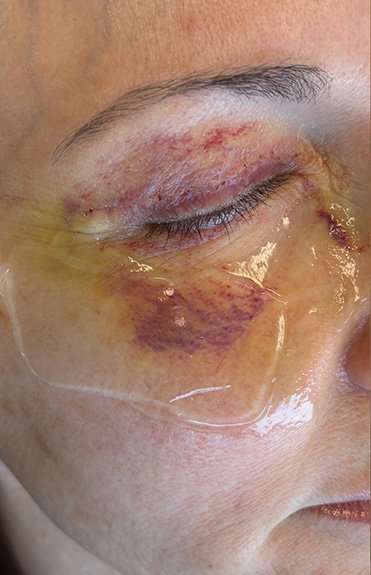 HALO/BBL Before & After Patient #1013