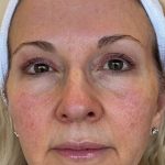 HALO/BBL Before & After Patient #1018