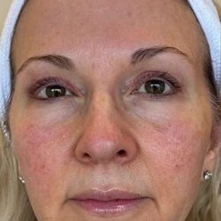 HALO/BBL Before & After Patient #1018