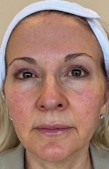 HALO/BBL Before & After Patient #1018