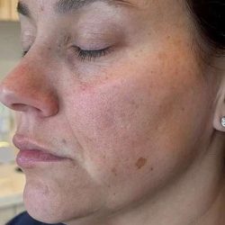 HALO/BBL Before & After Patient #1021