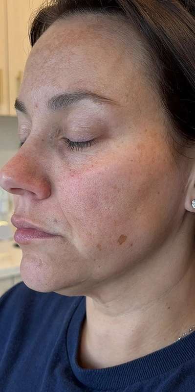 Microneedling + RF Before & After Patient #1024