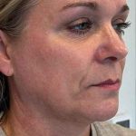 Microneedling + RF Before & After Patient #1027
