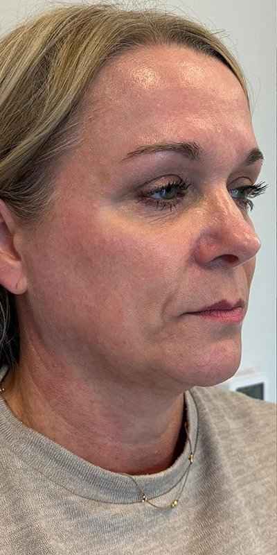 Microneedling + RF Before & After Patient #1027
