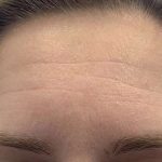 Botox/Dysport Before & After Patient #840