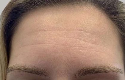 Botox/Dysport Before & After Patient #840