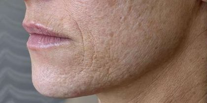 SkinPen Microneedling Before & After Patient #1030