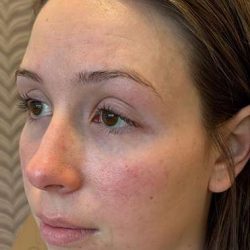 SkinPen Microneedling Before & After Patient #1033