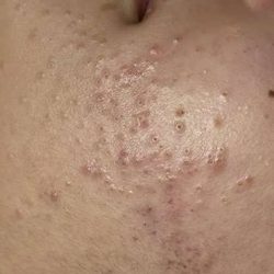 Facials Before & After Patient #1036
