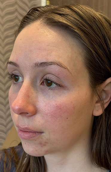Facials Before & After Patient #1039