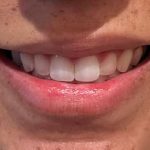 Botox/Dysport Before & After Patient #843