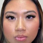 Botox/Dysport Before & After Patient #846