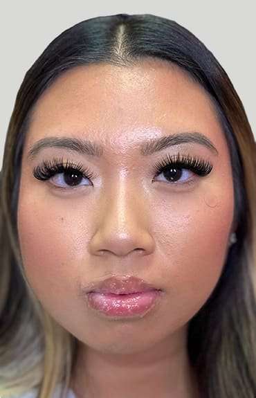 Botox/Dysport Before & After Patient #846