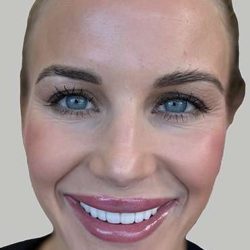 Botox/Dysport Before & After Patient #851