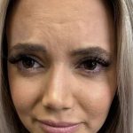 Botox/Dysport Before & After Patient #856
