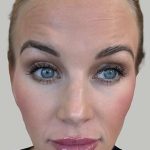 Botox/Dysport Before & After Patient #851