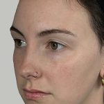 Full Facial Balancing Before & After Patient #914