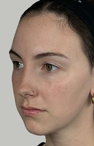 Full Facial Balancing Before & After Patient #914
