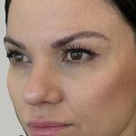 Full Facial Balancing Before & After Patient #919