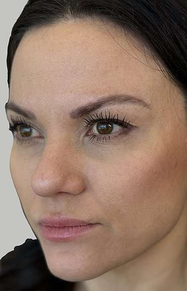 Full Facial Balancing Before & After Patient #919