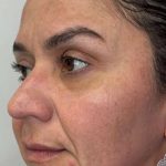 Full Facial Balancing Before & After Patient #924