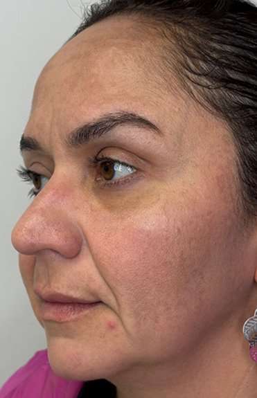 Full Facial Balancing Before & After Patient #924