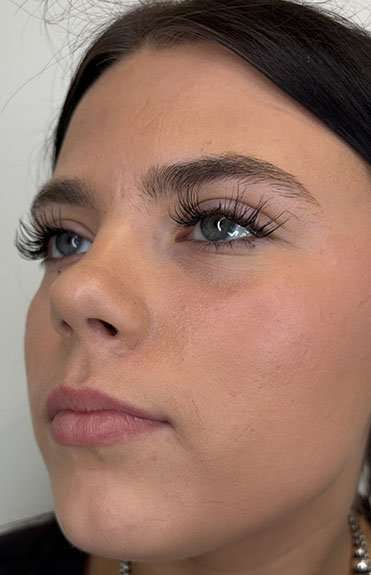 Lip Filler Before & After Patient #952