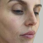 Lip Filler Before & After Patient #965