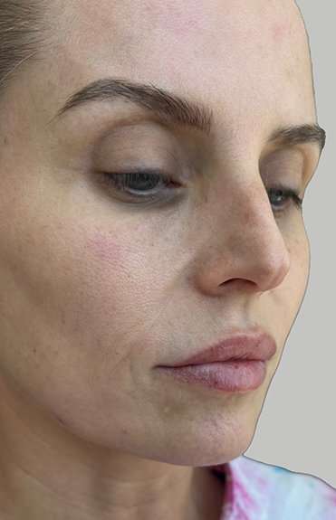 Lip Filler Before & After Patient #965