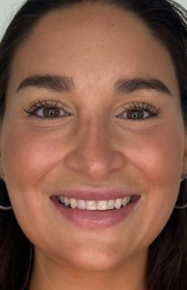 Lip Filler Before & After Patient #981
