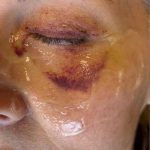 HALO/BBL Before & After Patient #1013