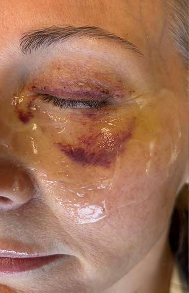 HALO/BBL Before & After Patient #1013