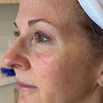 HALO/BBL Before & After Patient #1018