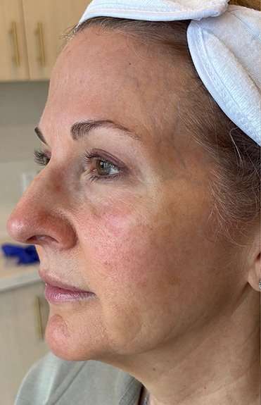 HALO/BBL Before & After Patient #1018