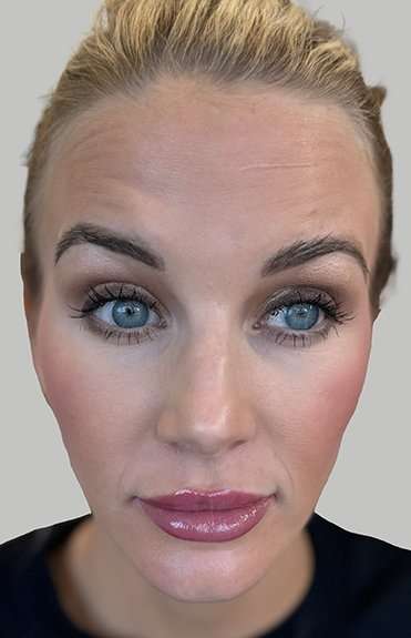 Botox/Dysport Before & After Patient #851