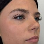 Lip Filler Before & After Patient #952