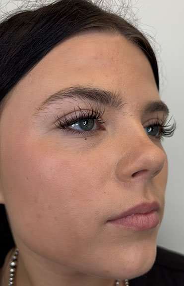 Lip Filler Before & After Patient #952