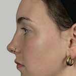 Full Facial Balancing Before & After Patient #914