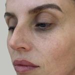 Lip Filler Before & After Patient #965