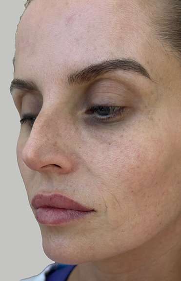 Lip Filler Before & After Patient #965