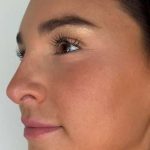 Lip Filler Before & After Patient #981