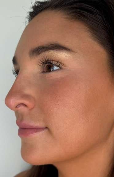Lip Filler Before & After Patient #981