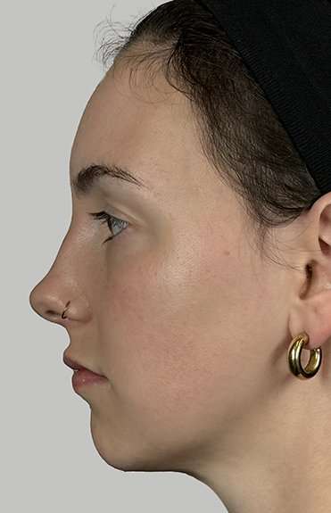Full Facial Balancing Before & After Patient #914